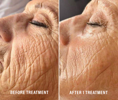 Donna+ Face Lifty Plus Glycolifting High Tension Kit