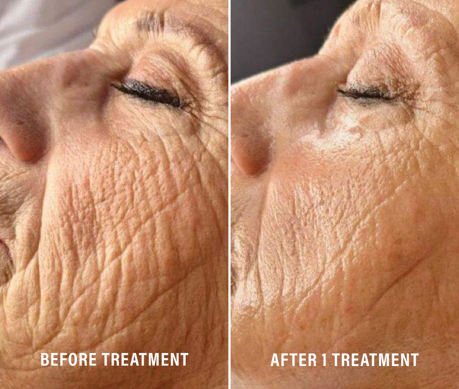 Donna+ Face LIFTY PLUS GLYCOLIFTING HIGH TENSION KIT