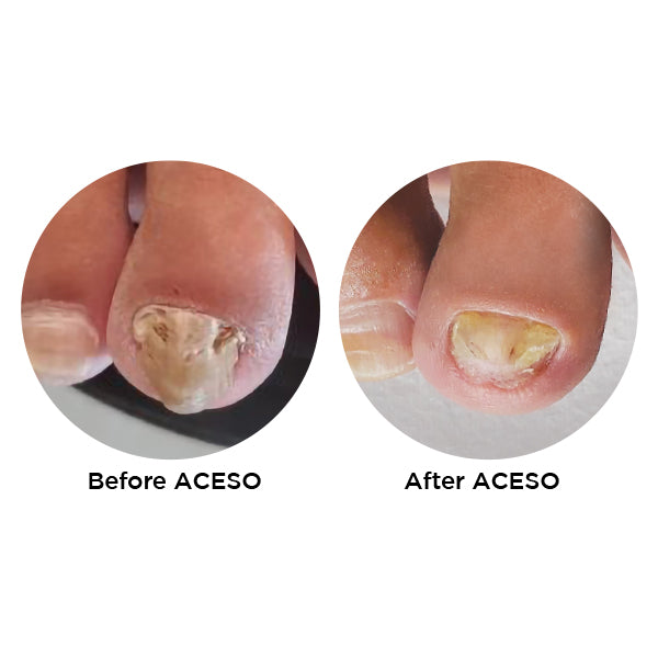 Famous Names Aceso Before and After; Powered By Natural Bio-Actives.