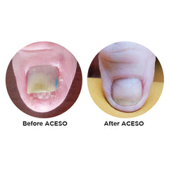 Famous Names Aceso Before and After; Powered By Natural Bio-Actives.
