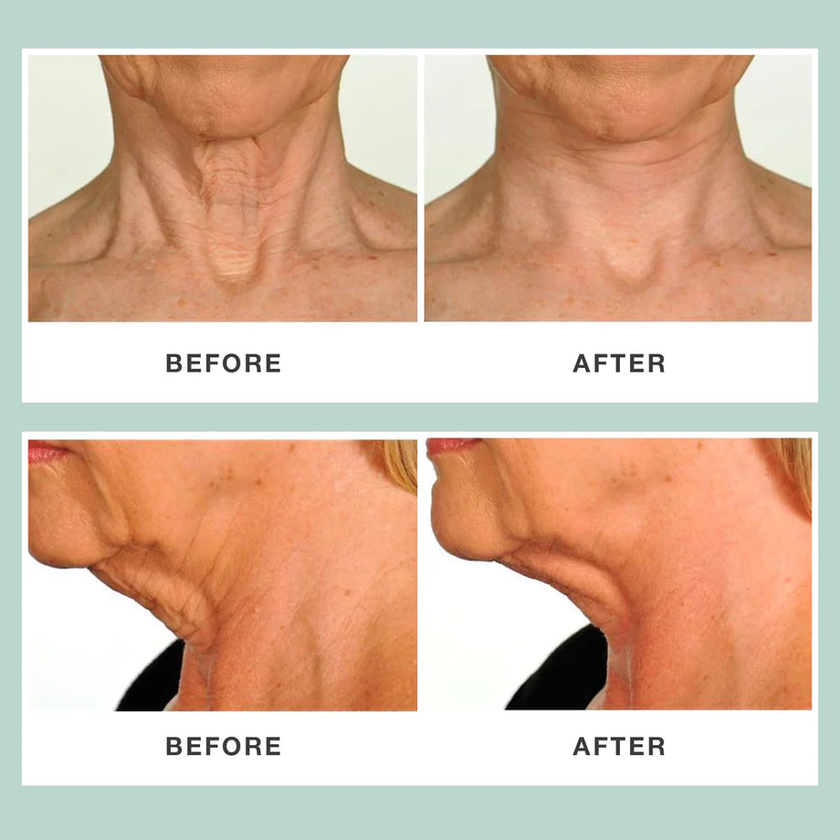 Contours Rx Neck Rescue 30 Strips